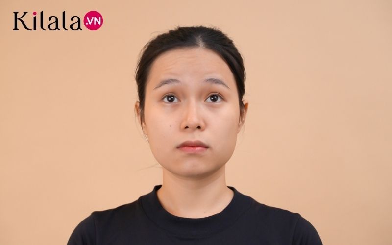 loại bỏ nếp nhăn trán loại bỏ nếp nhăn trán